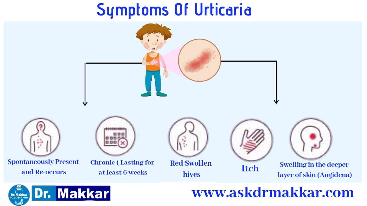 Symptoms of Urticaria